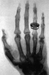 Röntgenbild von R. A. Köllikers Hand